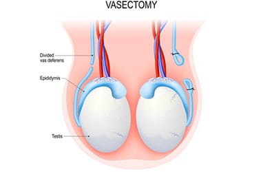 Learn more about Vasectomy