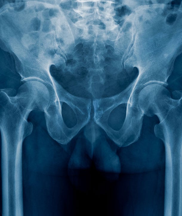 x-ray-of-pelvic-pain-due-to-interstitial-cystitis