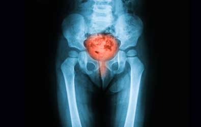 Learn more about Bladder Disorders