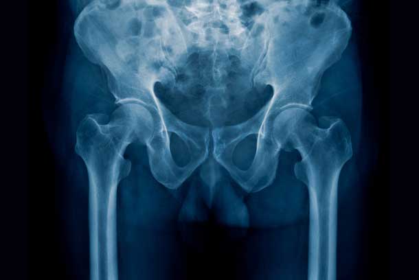 x-ray-of-pelvic-pain-in-need-of-Genitourinary-Fistula-Repair