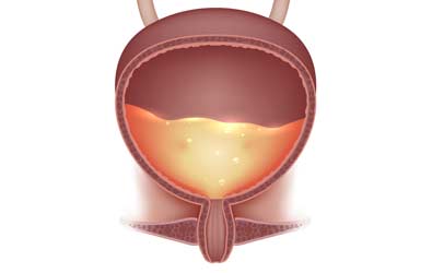 Learn more about Bladder Instillations