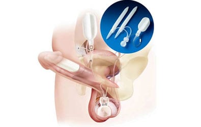 Penile-Prosthesis-Coloplast