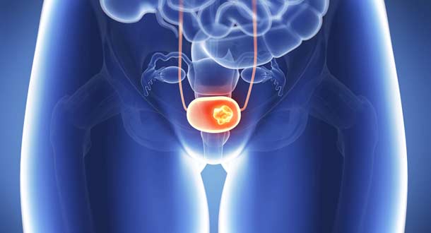 radical-cystectomy-for-bladder-cancer