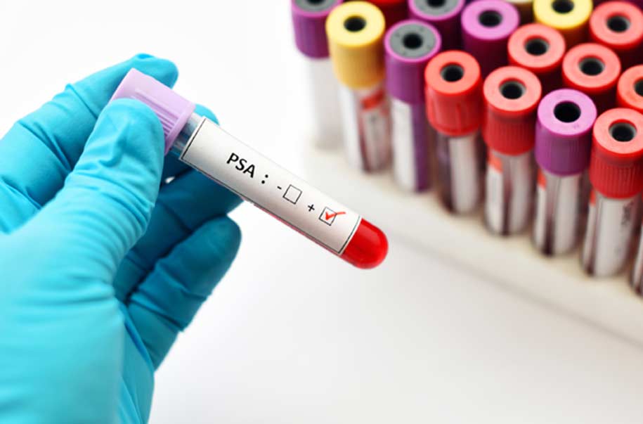 PSA-blood-test-before-prostate-biopsy-UCI-Urology