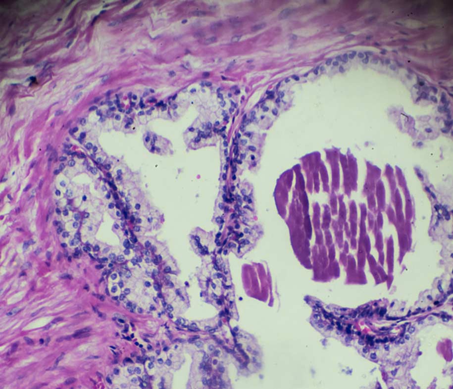 prostate-cells-prostate-biopsy-UCI-Urology