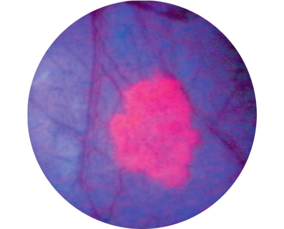 blue-light-cystoscopy