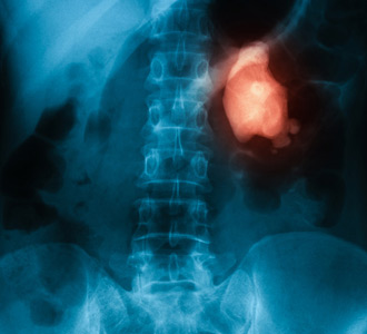 Kidney Stones & Kidney Disease