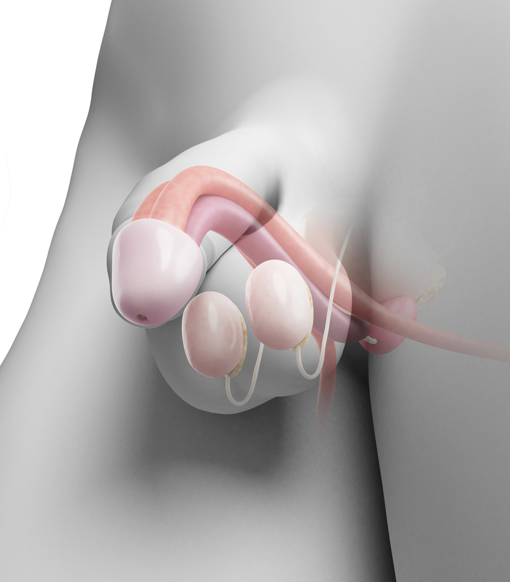 Microscopic-Vasectomy-Reversal-3