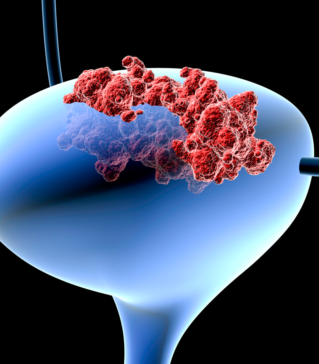 bladder-cancer-best-urology-surgeon-in-Orange-County