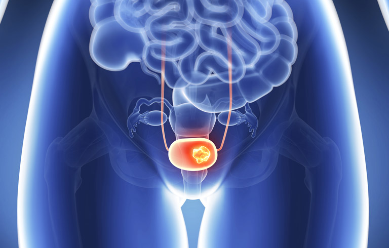bladder-surgery-for-bladder-cancer