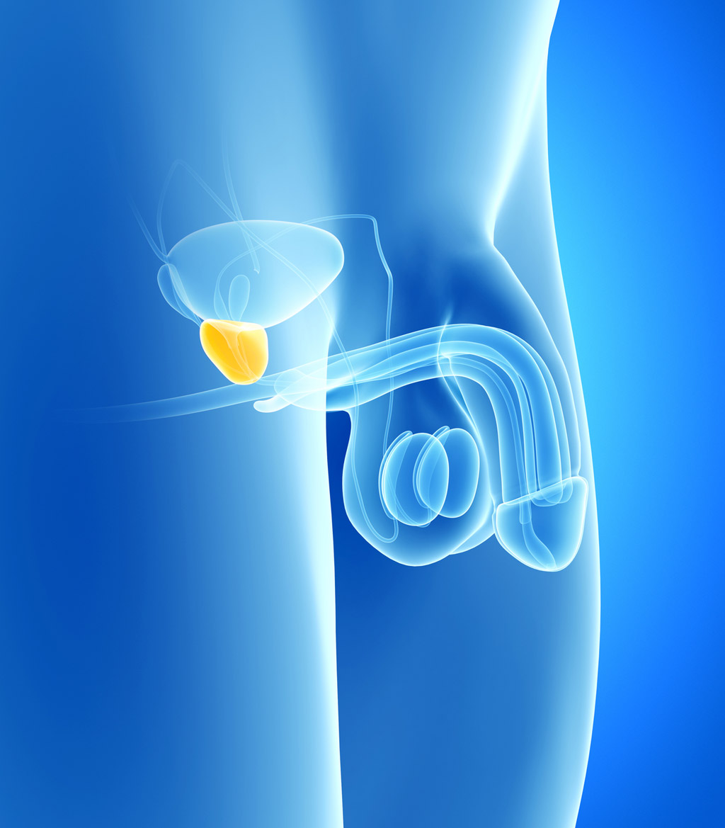 brachytherapy-for-prostate-cancer