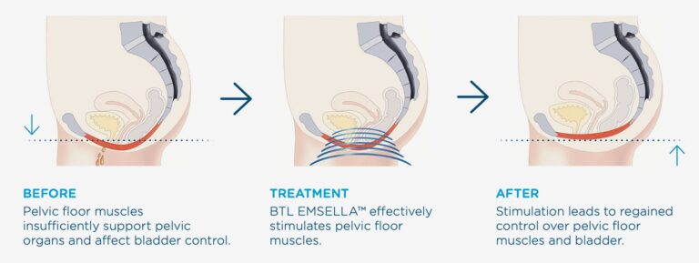 EMSELLA for Urinary Incontinence - Urologist | UC Irvine Department of ...