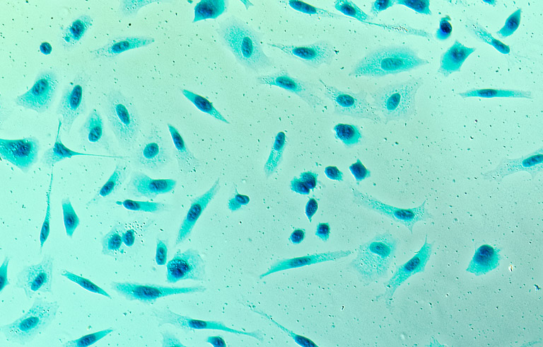 prostate-cancer-cells-MRI-fusion-biopsy-UCI-urology