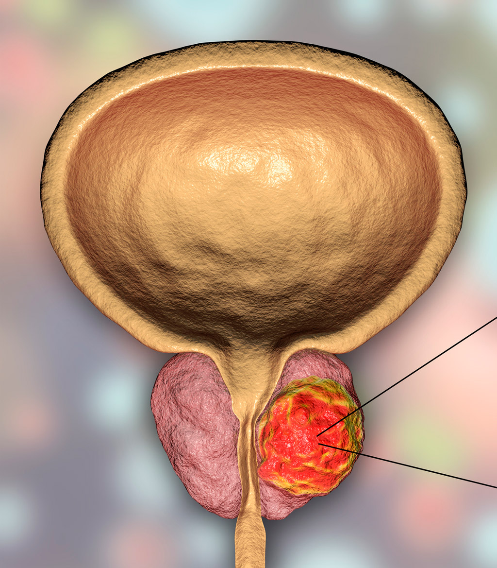 prostate-cancer-cprostate-cancer-concept-MRI-fusion-biopsy-UCI-Urologyoncept-MRI-fusion-biopsy-UCI-Urology
