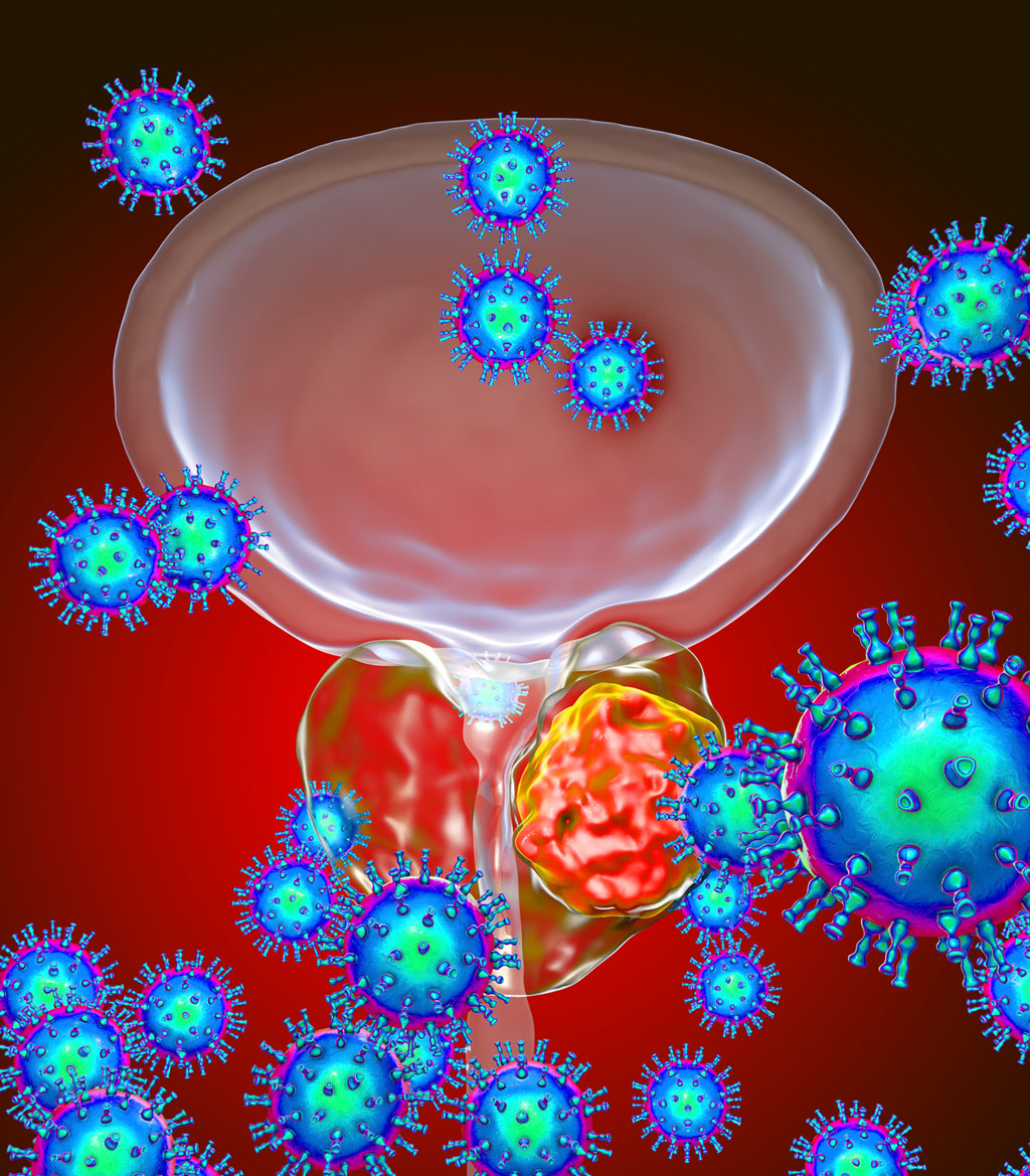 prostate-cancer-concept-da-Vinci-Surgical-System-UCI-Urology