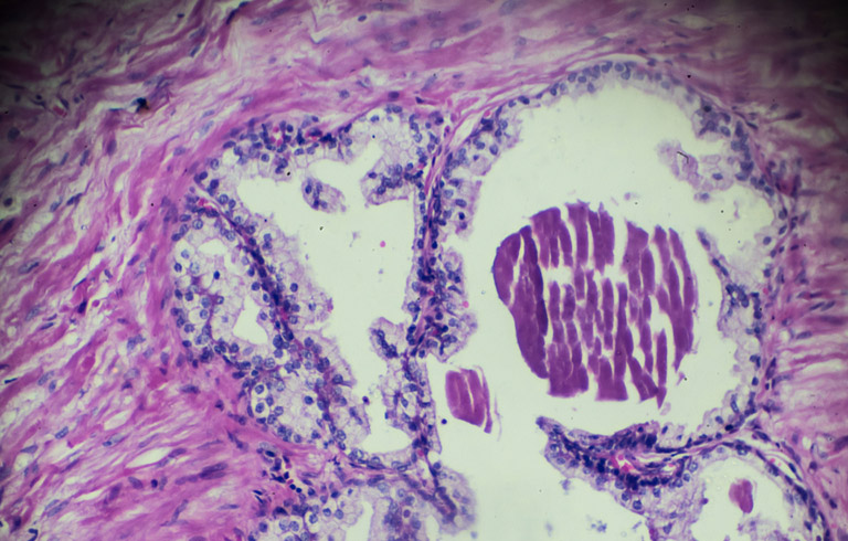 prostate-cells-prostate-biopsy-UCI-Urology