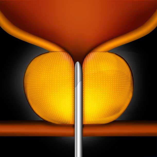 prostate-master-org-step-2