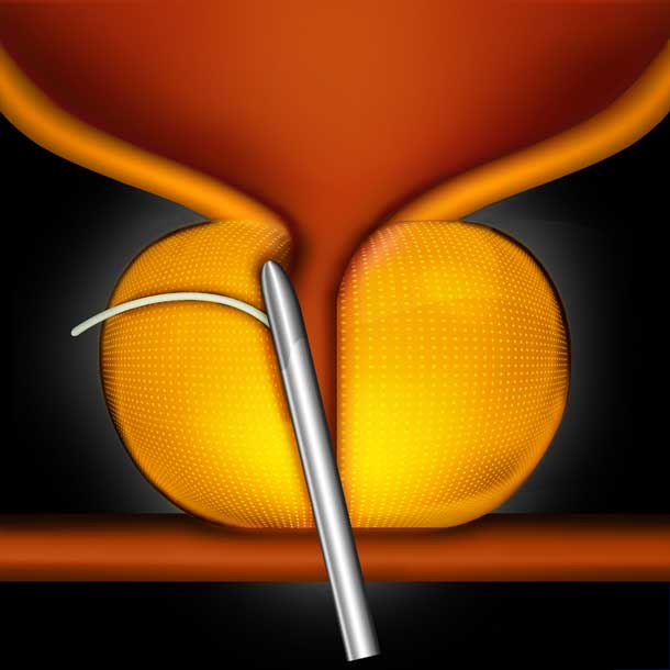 prostate-master-org-step-3