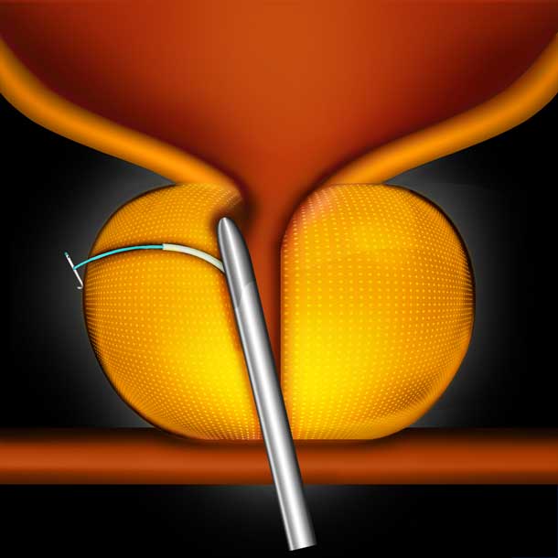 prostate-master-org-step-4