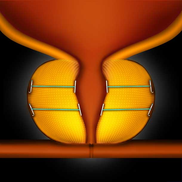 prostate-master-org-step-6