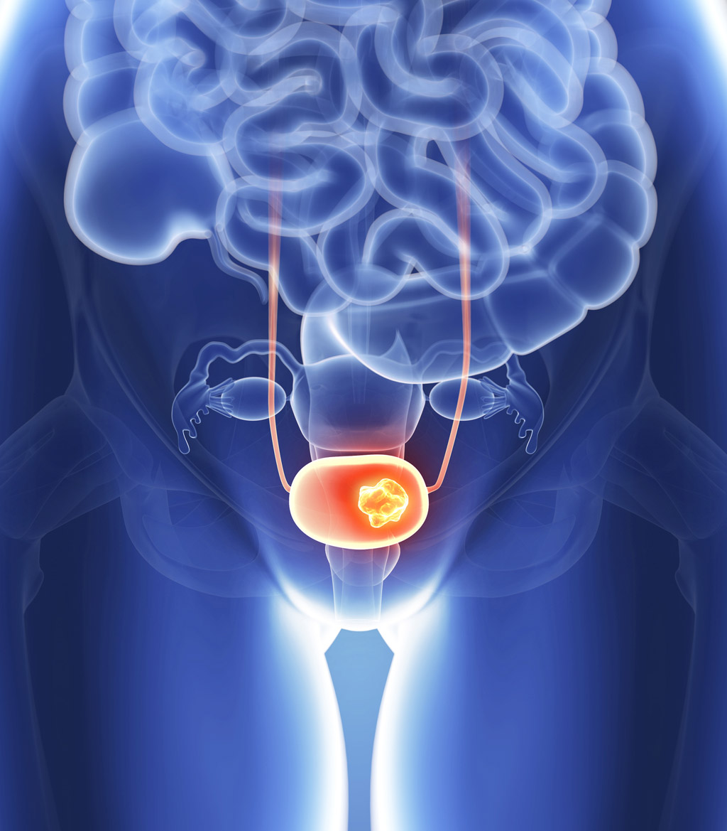 radical-cystectomy-for-bladder-cancer-2