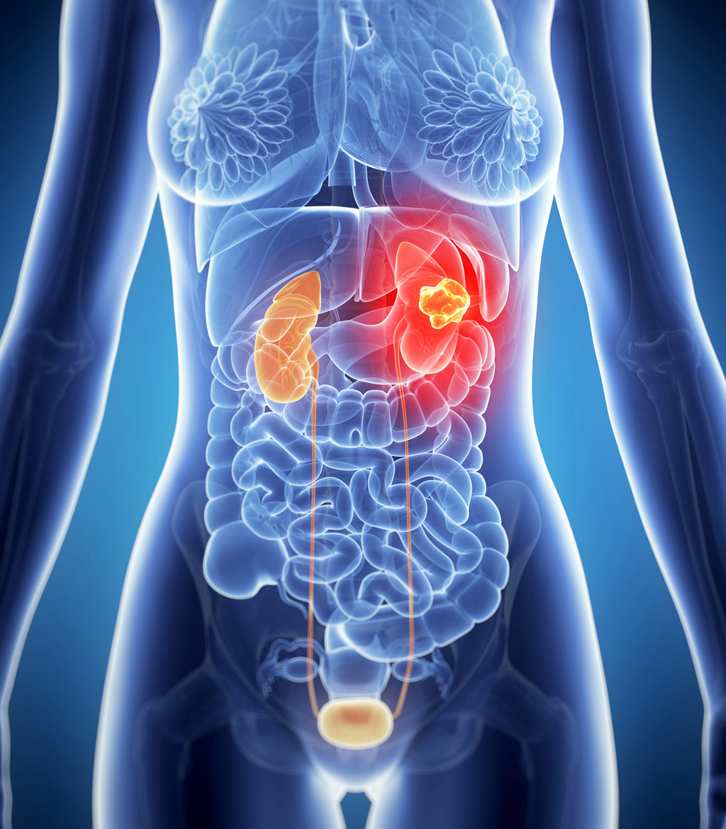 rapidarc-for-kidney-cancer