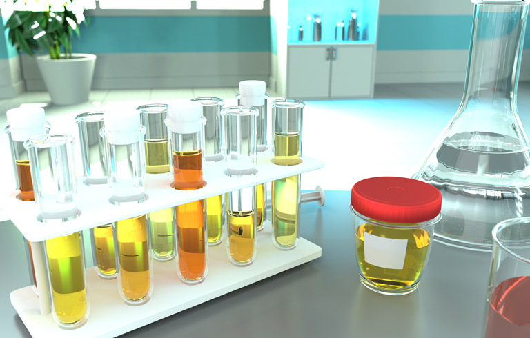 urine-quality-test-for-hematuria-best-urology-surgeon-in-Orange-County