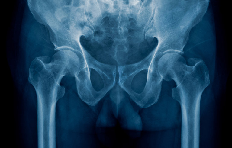 x-ray-of-pelvic-pain-due-to-interstitial-cystitis