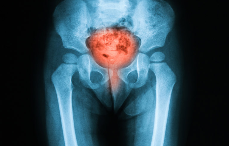 x-ray-of-urinary-tract-infection