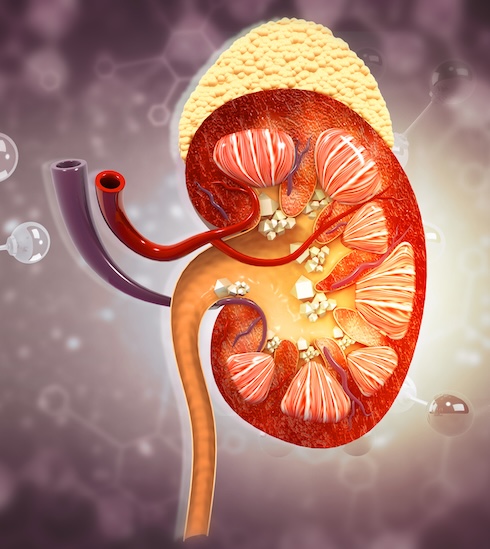 illustration of kidney stones