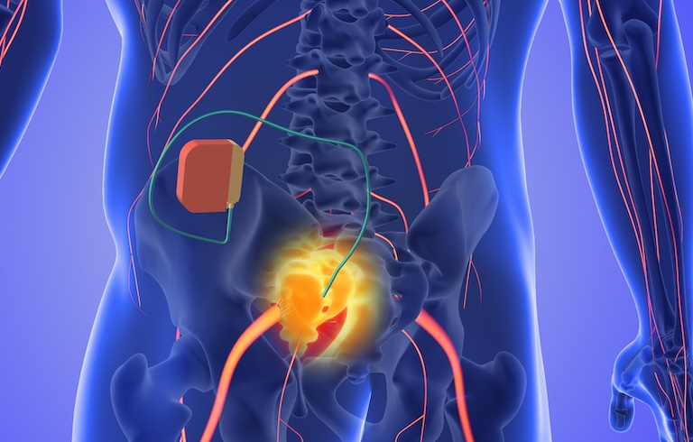 illustration of nueromodulator leads on bladder