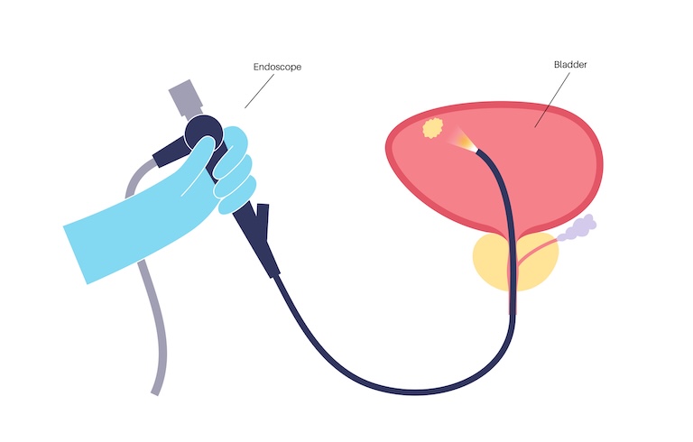 illustration showing cystoscope and bladder