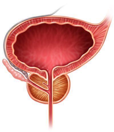 3D-illustration-of-prostate-gland-with-cancer-cells-before-calypso-fiducial-seed-placement