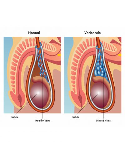 Illustration-of-Varicocele