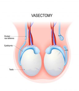 Illustration-of-a-vasectomy