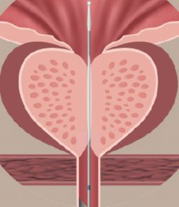 Optilume®-BPH-Catheter-System