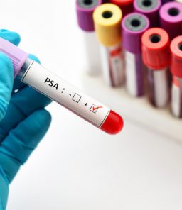 PSA-blood-test-before-prostate-biopsy-UCI-Urology