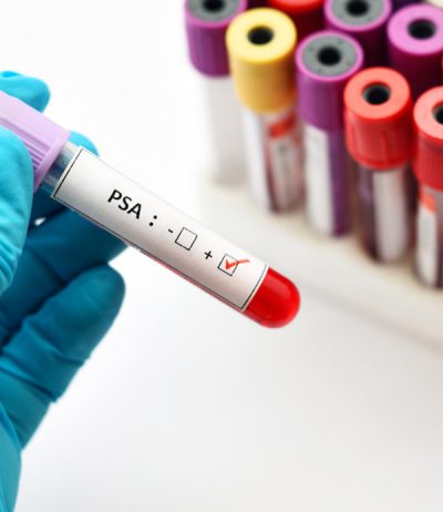 PSA-blood-test-before-prostate-biopsy-UCI-Urology