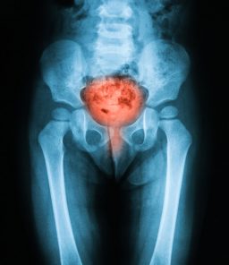 x-ray-of-bladder-disorder