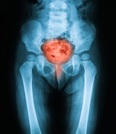 x-ray-of-bladder-disorder