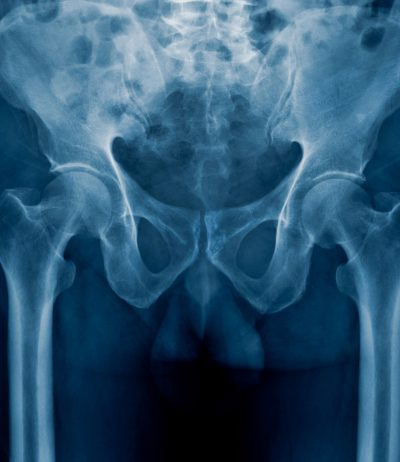 x-ray-of-pelvic-pain-in-need-of-Genitourinary-Fistula-Repair